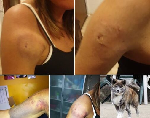 Consigliera azzannata da cane: “Amo gli animali, ma un bambino avrebbe perso il braccio”