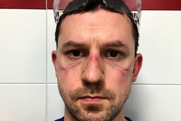 Il selfie dell’infermiere Nicola Sgarbi dopo 13 ore di turno