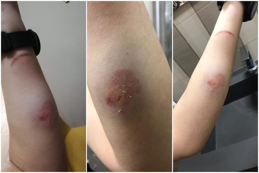 Ubriaco in ospedale, giovane prende a morsi infermiera: “Eravamo eroi solo durante il covid”