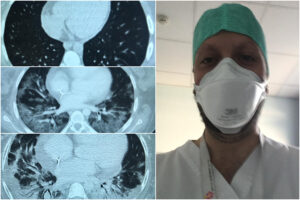 Covid, l’evoluzione della polmonite in tre foto, il medico: “In 20 giorni giovane paziente si sta degradando”