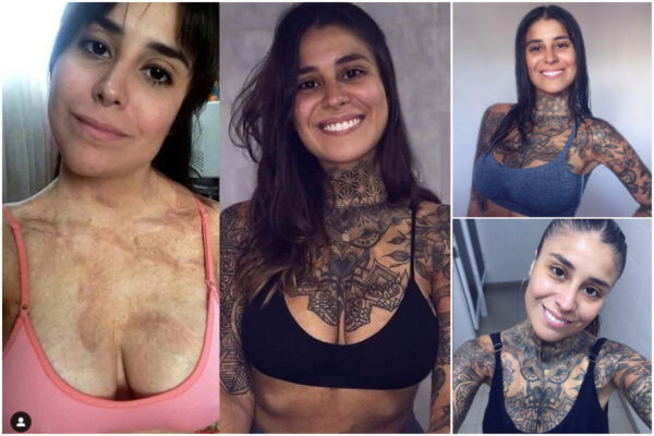 Ha ustioni su tutto il corpo ritorna a vivere grazie a tatuaggi curativi Ha ustioni su tutto il corpo ritorna a vivere grazie a tatuaggi curativi