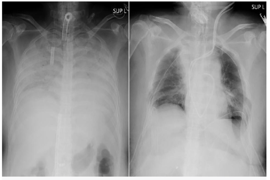 Foto: Kyoto University
A sinistra i polmoni prima del trapianto, a destra dopo