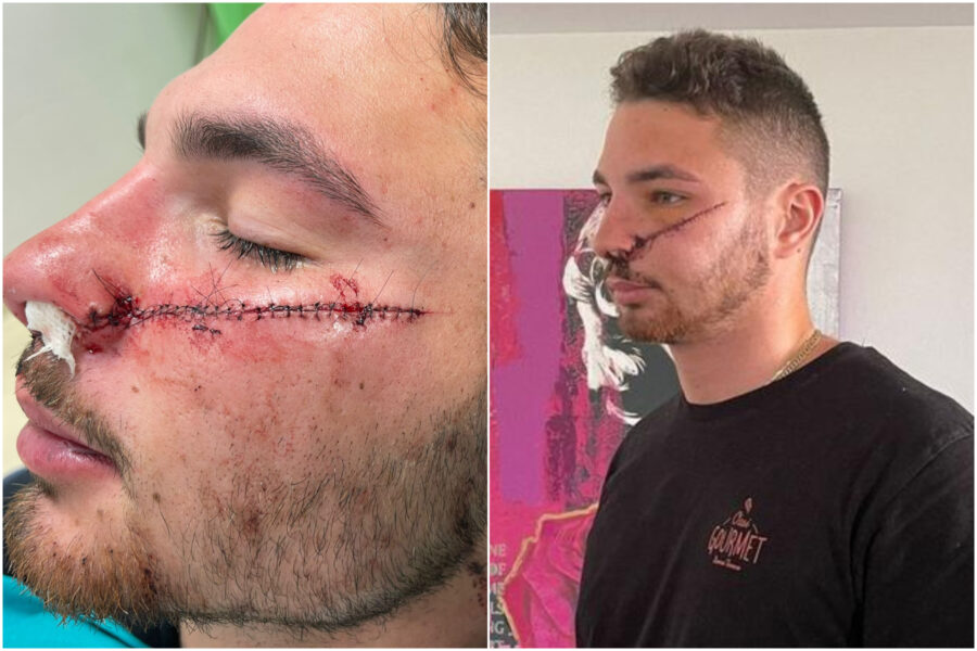 Sfregiato per difendere l’amica, oltre 30mila euro raccolti per il rider Michele Dal Forno