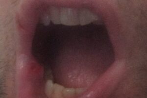 Aggredito nella metro C di Roma: verificatore in ospedale Aggredito nella metro C di Roma: verificatore in ospedale