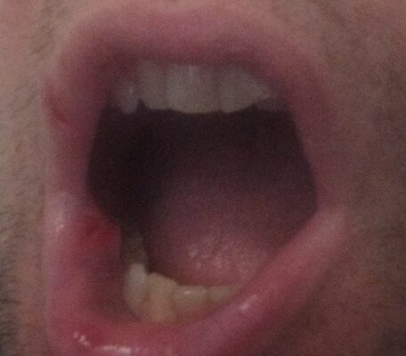 Aggredito nella metro C di Roma: verificatore in ospedale