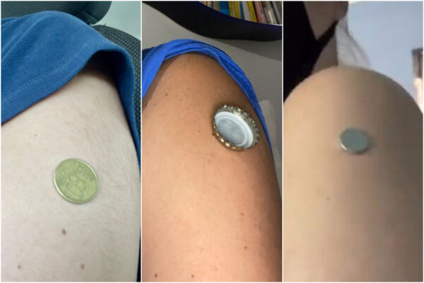 La moneta si attacca al braccio dopo il vaccino, la spiegazione: nessun microchip o magnetismo