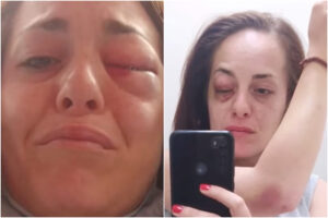 Giuliana Danzè, la cantante mostra il volto tumefatto dalle violenze: picchiata dal compagno