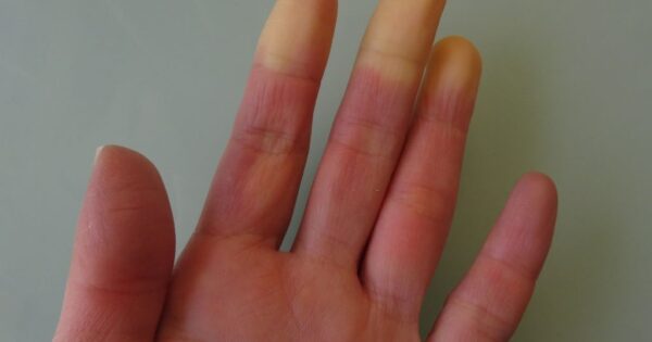 A hand with Raynaud syndrome symptom appearing on the cold glass table, which is one of the common symptoms of connective tissue disease.