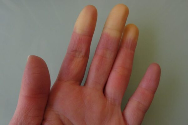 A hand with Raynaud syndrome symptom appearing on the cold glass table, which is one of the common symptoms of connective tissue disease.