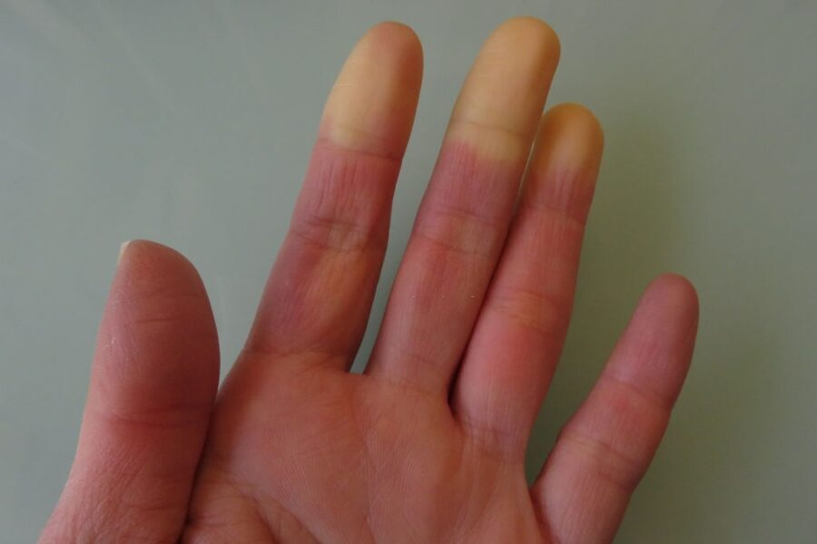 A hand with Raynaud syndrome symptom appearing on the cold glass table, which is one of the common symptoms of connective tissue disease.
