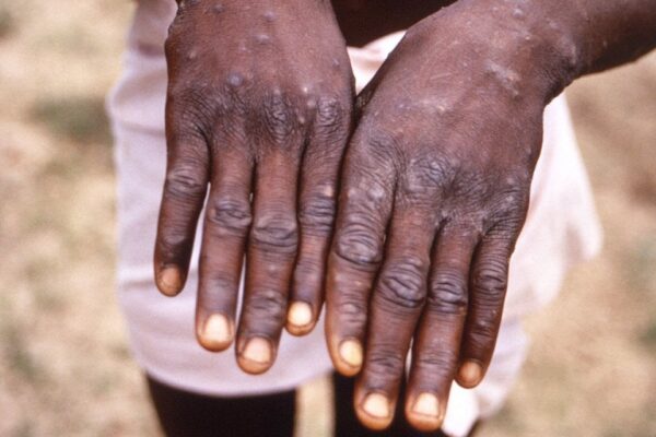 Vaiolo delle scimmie, come si trasmette e quali sono i sintomi: ricoverato in Italia il primo contagiato Vaiolo delle scimmie, come si trasmette e quali sono i sintomi: ricoverato in Italia il primo contagiato