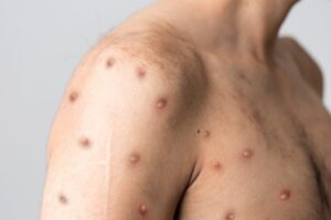 Vaiolo delle scimmie, primo caso in Campania: è un 40enne in isolamento