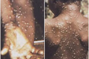 Vaiolo delle scimmie, il contagio può avvenire attraverso l’aria? Gli USA: “Indossate la mascherina”