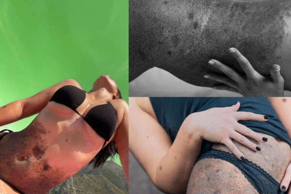 Chi è Pia Salatino e cosa è il nevo melanocitico gigante: “Rivendico l’essere diversa”