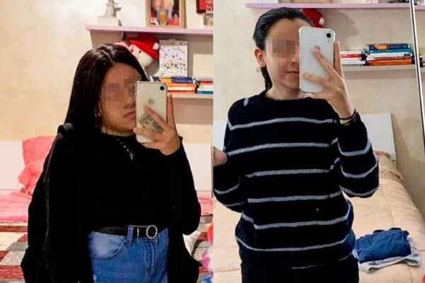 Operata alla schiena per una cifo-scoliosi, Linda ‘recupera’ 15 centimetri di altezza: negli Usa avrebbe pagato un milione di dollari