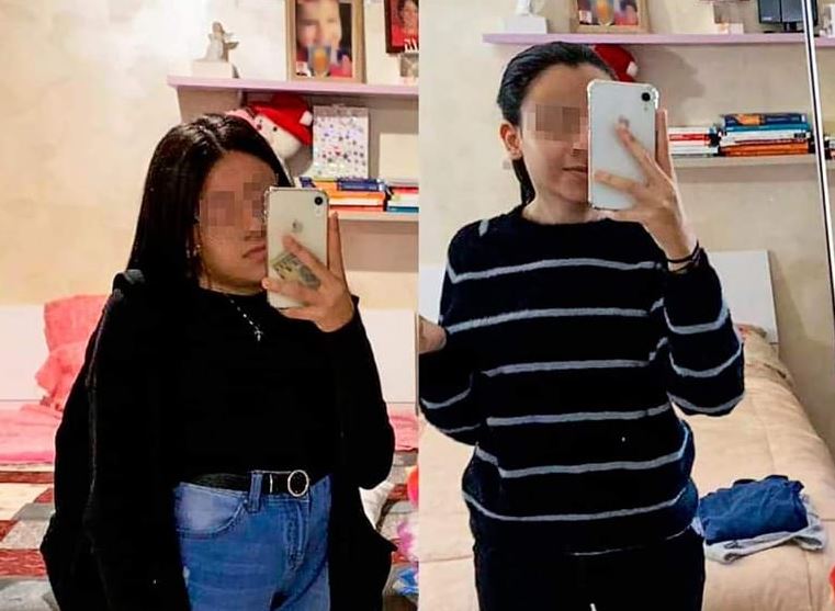 Operata alla schiena per una cifo-scoliosi, Linda ‘recupera’ 15 centimetri di altezza: negli Usa avrebbe pagato un milione di dollari