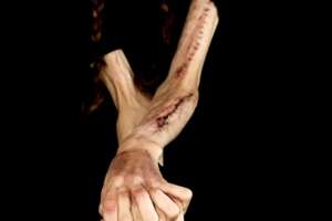 Che cos’è il Cutting, il comportamento di autolesionismo che può diffondersi tra i giovani come un’epidemia