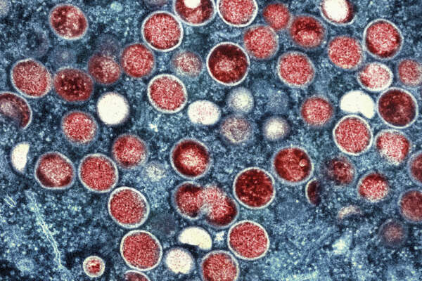 This image provided by the National Institute of Allergy and Infectious Diseases (NIAID) shows a colorized transmission electron micrograph of monkeypox particles (red) found within an infected cell (blue), cultured in the laboratory that was captured and color-enhanced at the NIAID Integrated Research Facility (IRF) in Fort Detrick, Md.  The World Health Organization recently declared the expanding monkeypox outbreak a global emergency.  It is WHO’s highest level of alert, but the designation does not necessarily mean a disease is particularly transmissible or lethal. (NIAID via AP)