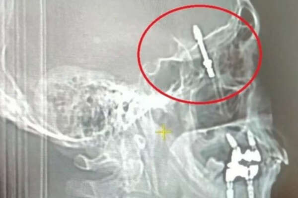 Urla disperato per il dolore atroce ma il dentista dice che è normale: “Ha spinto troppo, rotto la mascella e conficcato la vite nel cranio”. Uomo salvo per miracolo