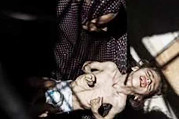 Fame a Gaza, confutazioni e accuse sulla piccola Misk: la bimba di 6 anni nata con atrofia cerebrale