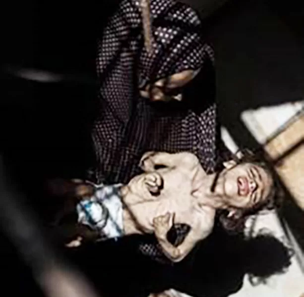 Fame a Gaza, confutazioni e accuse sulla piccola Misk: la bimba di 6 anni nata con atrofia cerebrale